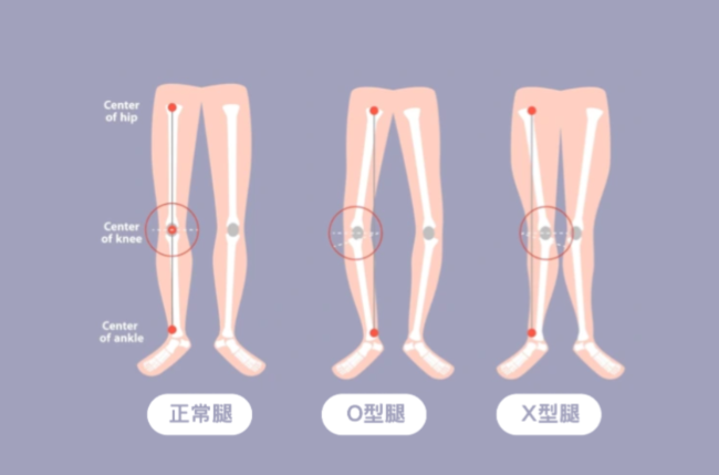 O型腿