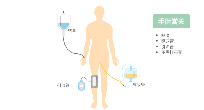 高位脛骨截骨矯正手術-手術當天