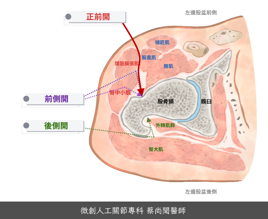 正前開髖關節手術-蔡尚聞